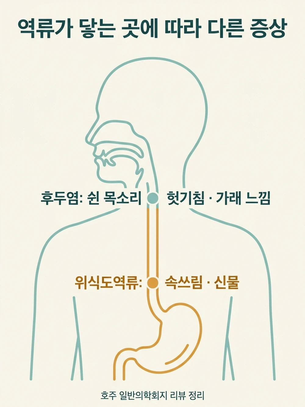 역류성 후두염과 위식도역류질환은 역류가 닿는 자리에 따라 불편한 곳이 달라집니다