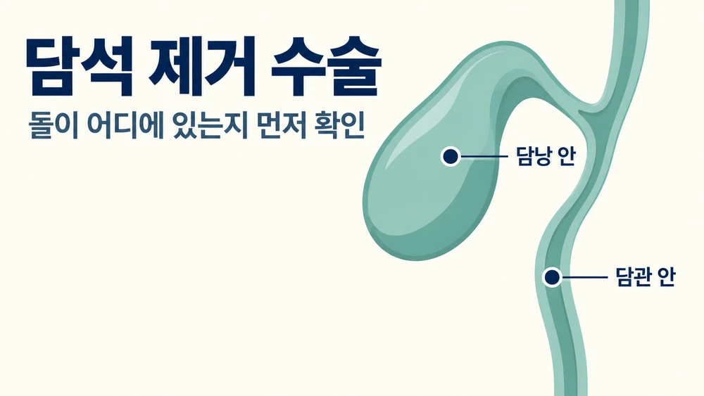 담석 제거 수술, 돌만 빼고 담낭은 남길 수 있을까?
